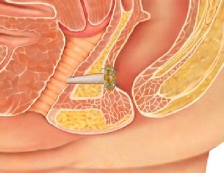 Perianal Abscess Fistula In Ano Causes Treatment Surgery