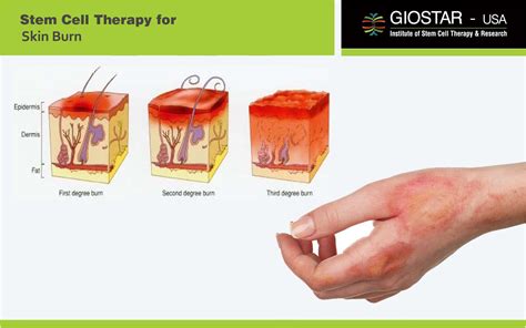 Stem Cell Therapy For Skin Burn Treatment For Skin Burn In India