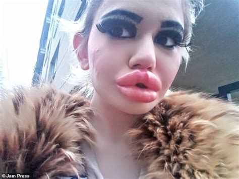 Woman Who Has Spent Thousands Quadrupling The Size Of Her Lips In A Quest To Have The World