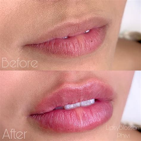 Needleless Lip Filler Pen Chin Reduction Non Surgical In Ct