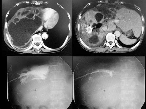 Ct Findings And Fistulography Of Massive Right Subphrenic Fluid