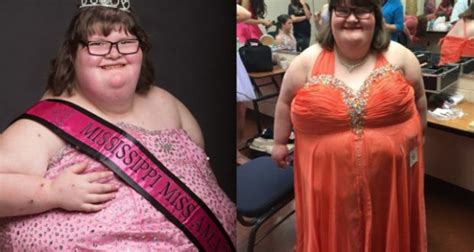 15 Girl 380 Lbs Faces Genetic Disorder Win Pageant Queen 2 620x330 Q