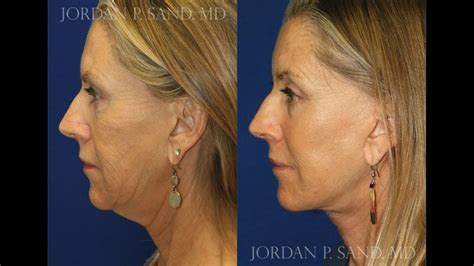 Patient Facelift Journey 2 Spokane Center For Facial Plastic Surgery Youtube