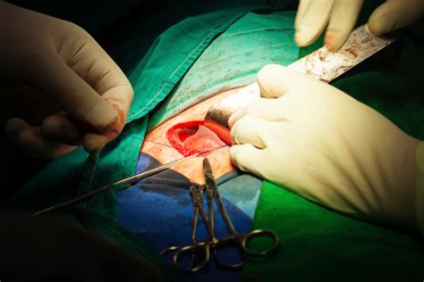 It is worth noting that although mesh repairs are now the most common technique for repair of inguinal hernias, the shouldice. Inguinal Hernia Surgery Stock Photo - Download Image Now ...