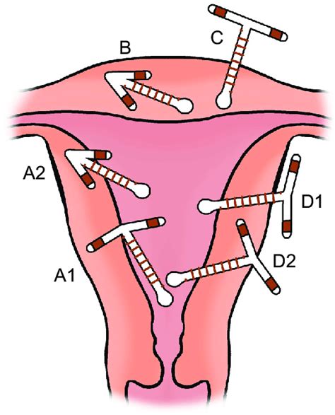 [diagram] Uterus Diagram Iud Mydiagram Online