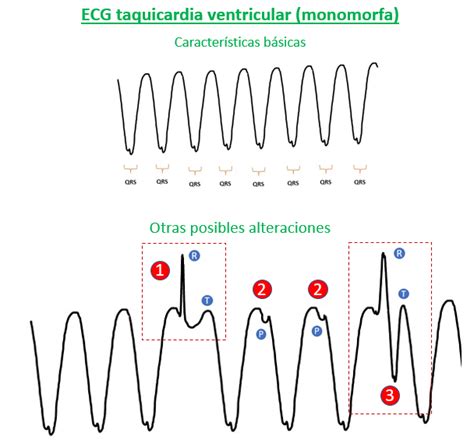 Criterios De Taquicardia Ventricular En El Electrocardiograma My XXX