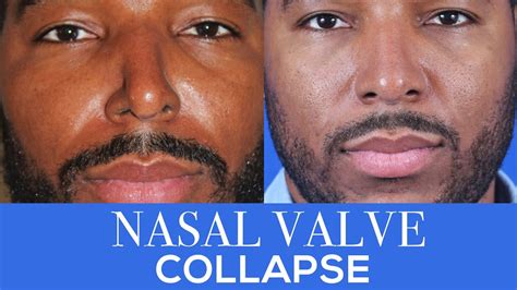 10 Nasal Valve Collapse Surgery Before And After Saphireammara