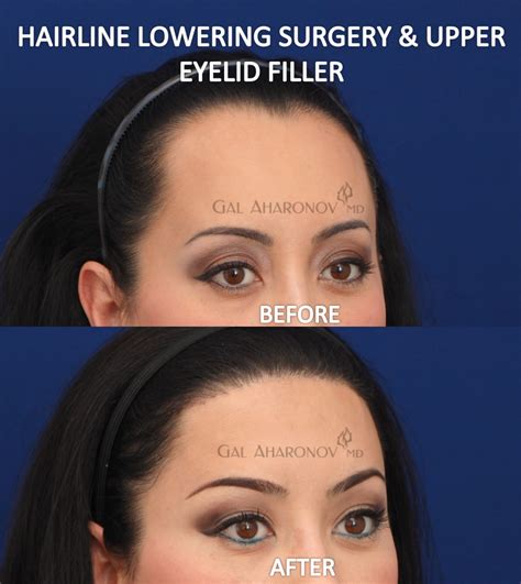 Forehead Reduction Surgery Hairline Lowering Surgery Before And After