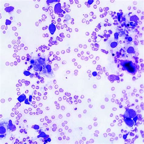 Pathogenesis Of Hemophagocytic Lymphohistiocytosis The Function Of