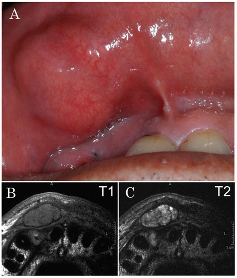 Carcinoma Ex Pleomorphic Adenoma Of The Upper Lip A Case Of An Unusual