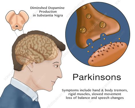 Dopamine And Parkinsons Illustration Stock Image C0365455