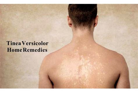 Tinea Versicolor Home Remedies And Diet Tips For Faster Recovery