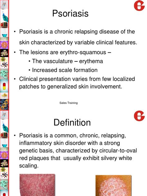 Psoriasis And Mgt Psoriasis Topical Medication