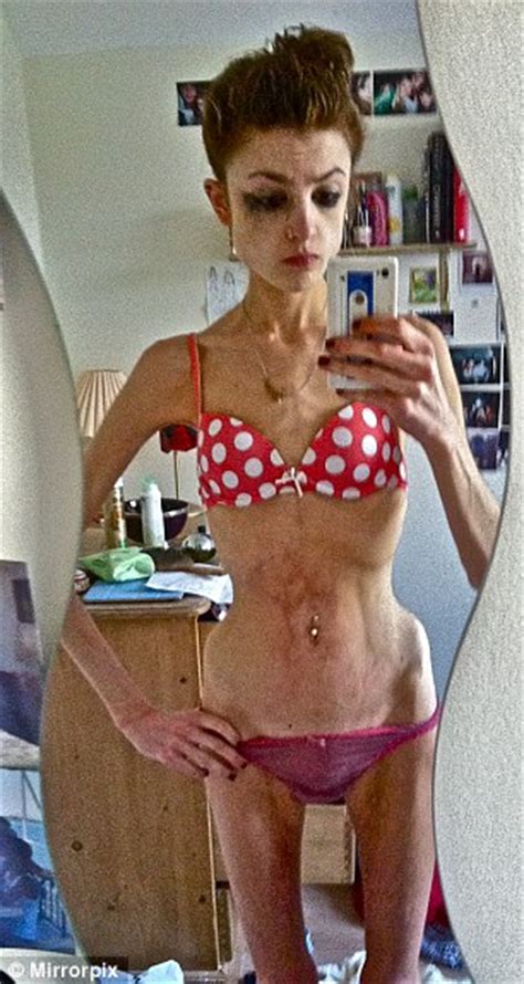 Recovering Anorexic Lydia Davies Who Weighed 4st 11lb Wants To Help
