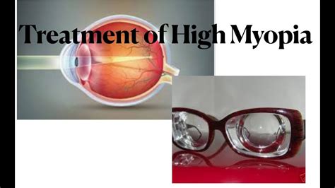 Treatment Of High Myopia Youtube