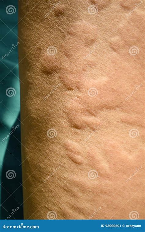 Skin Rash As Allergic Symptoms Due To Arm Fiberglass Cast Stock