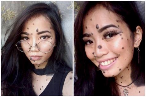 Malaysian Girl Covered In Moles Aspires To Be Miss Universe And It Is Awesome
