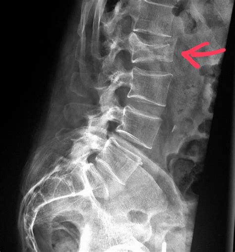 Compression Fracture X Ray Mapasgmaes