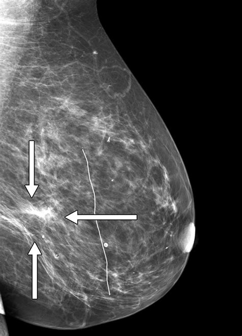 Architectural Distortion Of The Breast Ajr