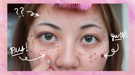 Results Of Acne Laser Treatment Before After Youtube
