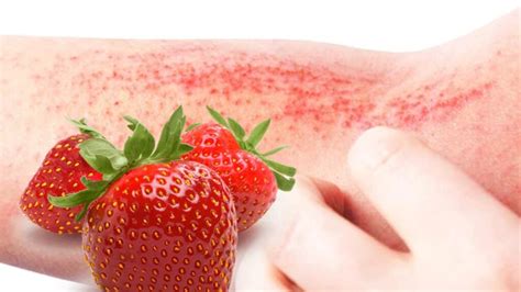 Strawberry Allergy Symptoms And How To Treat It