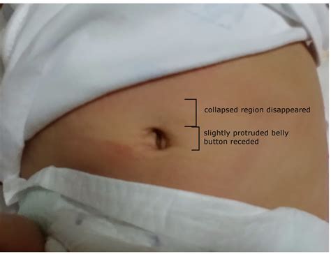 The spot becomes larger and harder when the baby cries, coughs, or strains, due to the increase of pressure on the abdomen. About my lil buds: Baby belly button from hernia-like to normal (updated)
