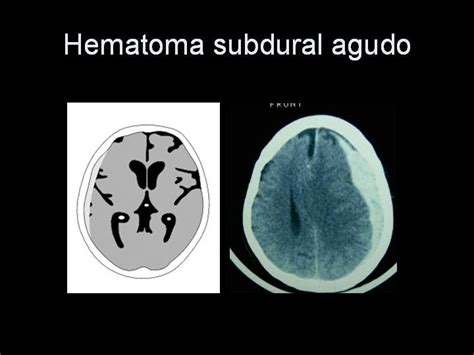 Hematoma Subdural Agudo