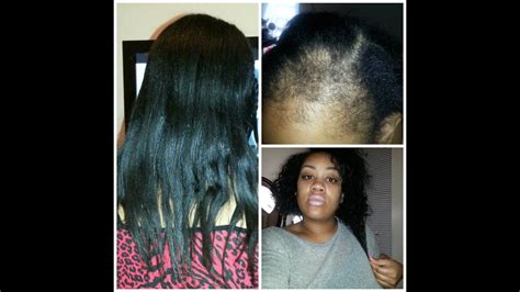 Losing some hair isn't necessarily a sign of a problem. Hair woes: Postpartum alopecia hair loss, Hairfinity, Hair ...
