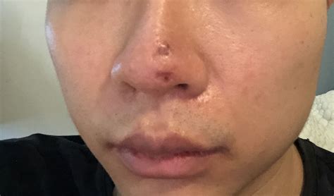 Deep Acne Scars On Nose Scar Treatments Forum