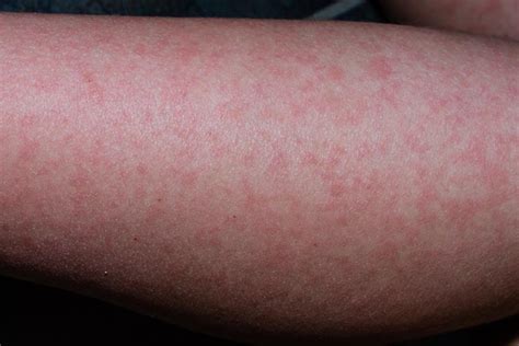 Viral Rashes In Babies Types Pictures Diagnosis Treatment