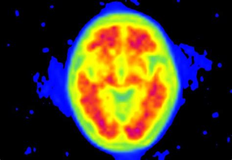 Pet Scans For Alzheimers Could Bring Benefit To More Patients