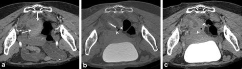 Percutaneous Cryoablation For The Management Of Chronic Pain Secondary