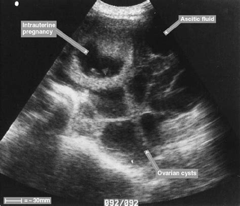 Pelvic Ultrasound Scan Of A 26 Year Old Pregnant Patient With Ovarian