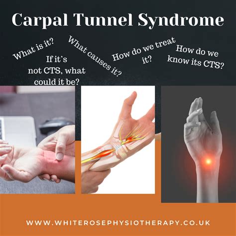 Carpal Tunnel Syndrome White Rose Physiotherapy