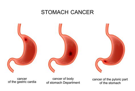 Gastric Cancer5