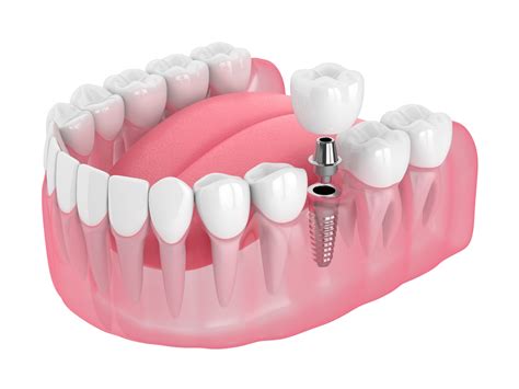 Dental Implant With A Crown Is This The Right Option For You Cr