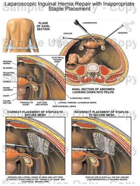 Laparoscopic Inguinal Anatomy The Best Porn Website