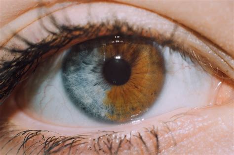 My Friends Iris Is Split In Half Different Colored Eyes Rare Eye