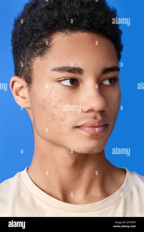 African American Teenage Boy With Acne Problem On Color Background