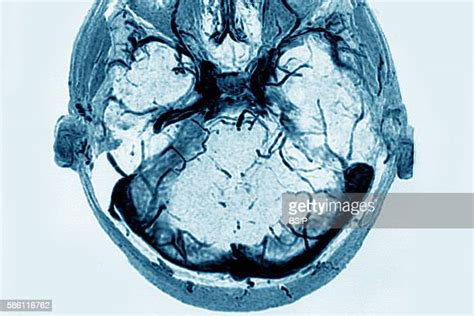 Cerebral Venous Sinus Thrombosis Photos And Premium High Res Pictures
