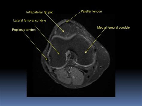 Knee Muscle Anatomy Mri Use The Mouse To Scroll Or The Arrows Mr