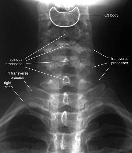 Radiographic Anatomy Of The Skeleton Cervical Spine Anteroposterior