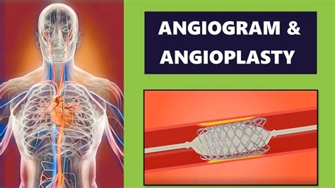 Angiogram And Coronary Angioplasty Procedure Cardiology Youtube