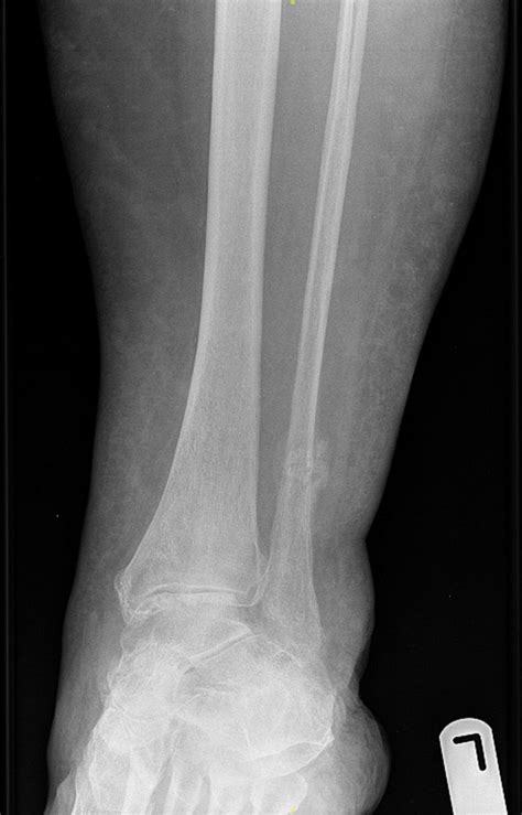 Fibular Insufficiency Fracture An Under Reported Complication Of