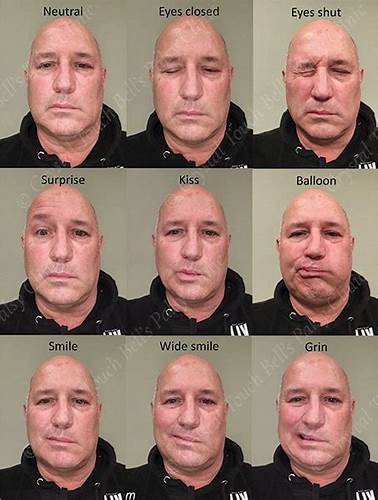 Диета неврит лицевого нерва Длительное восстановление после неврита лицевого нерва (хронология Длительное восстановление после неврита лицевого нерва (хронология Диета неврит лицевого нерва