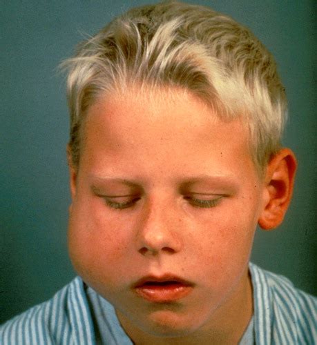 Causes Of Facial Swelling In Pediatric Patients Correlation Of