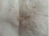 Pictures of Lice Eggs After Treatment