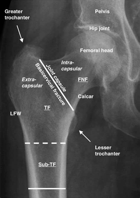 1 Anteroposterior Radiograph Of The Right Side Of The Proximal Femur
