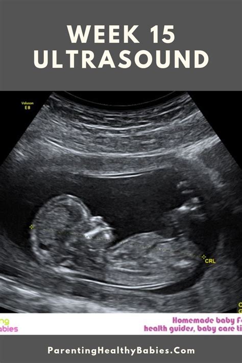Week 15 Of Pregnancy Pregnancy Week By Week 15 Week Ultrasound Pregnancy Ultrasound Ultrasound
