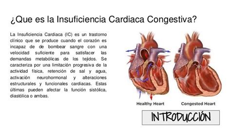 Insuficiencia Cardiaca Congestica Icc